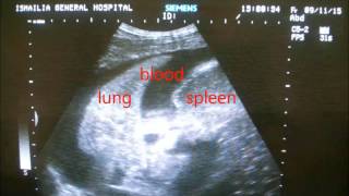 A quick diagnosis of hemothorax by ultrasound [upl. by Rahr]