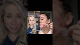 Dermatologist Reacts to Hydrocolloid Pimple Patch Removal shorts [upl. by Glaser]