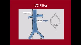 Management of DVTPulmonary Embolus [upl. by Liane160]