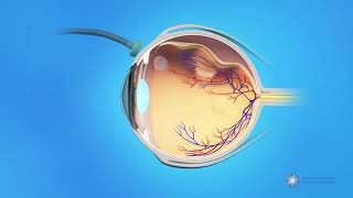 Vitrectomy Surgery for Detached Retina [upl. by Suiddaht]