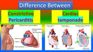 Difference Between Constrictive Pericarditis and Cardiac Tamponade [upl. by Klara148]