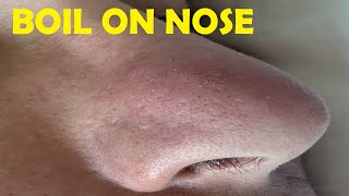 how to get rid of a boil on your nose overnight [upl. by Ettenad117]