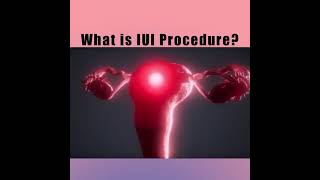 Intrauterine Insemination IUI for Pregnancy [upl. by Converse]