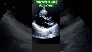 Parasternal long axis view shortvideo viralshorts trending doctor neet medicallover [upl. by Theta237]