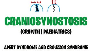 CRANIOSYNOSTOSIS  PAEDIATRICS  GROWTH  APERT SYNDROME  CROUZZON SYNDROME  MEDVIDSMADESIMPLE [upl. by Aden898]