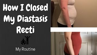 How I Closed My Diastasis Recti  My Routine [upl. by Bracci]