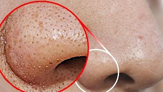 how to remove blackheads from nose and chin area naturally and permanently  DIY blackhead removal [upl. by Derk548]