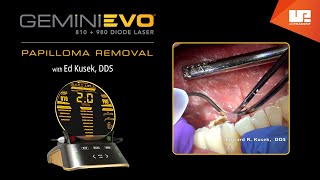 Papilloma Removal  Gemini™ EVO clinical cases [upl. by Kurtis220]