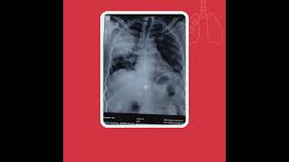 A Case of Right Lobar Pneumonia with Septic Shock advancedtechnology healthcarefacility [upl. by Akirahs]