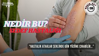 Nedir bu Sedef hastalığı Belirtileri neler Türleri neler Bulaşıcı mı quotKesin bir tedavisi yok…quot [upl. by Patt]