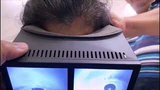 Multicanal BPPV with Canal Switch and Jam [upl. by Naylor]