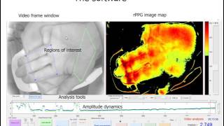 Photoplethysmography imaging algorithm for continuous monitoring of regional anesthesia [upl. by Sitoeht]