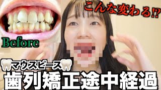 【歯列矯正】半年経過！大きな変化に正直びっくりしてる…｜マウスピース🦷 [upl. by Franek490]