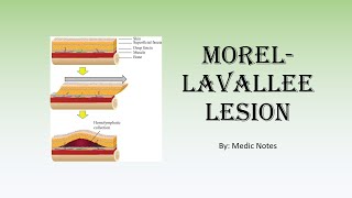 Morellavallee lesion  causes signs and symptoms investigation treatment [upl. by Ecaroh]