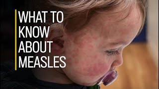 What to know about measles [upl. by Novled]