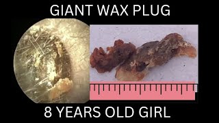 8 years old girl suffering from GIANT EARWAX PLUG [upl. by Ibmab]