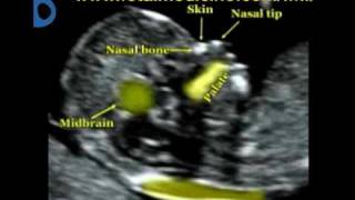 Fetal Medicine Foundation  Nuchal translucency [upl. by Ellerrehc]