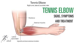 Tennis elbow Signs and symptoms and treatment of the common elbow injury [upl. by Pickens]