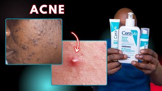 The 5 Essential Cerave Products Every Acne Sufferer Needs [upl. by Jeno214]