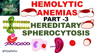 Hemolytic Anemias Part 3 HEREDITARY SPHEROCYTOSIS [upl. by Jodie]