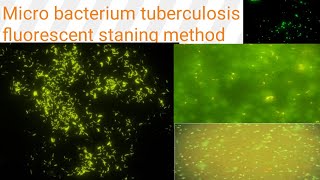 AuramineRhodamine staining on fluorescent microscopy Diagnosis of TB Microbacterium tuberculosis [upl. by Malinde]