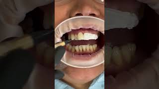 New Veneers Process dentaltreatment veneers [upl. by Zetana]