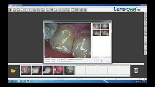 Lensiora HD Intraoral Camera Examination with VixWin Gendex [upl. by Krystle]