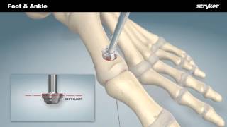 Stryker Foot and Ankle  Anchorage® CP Plating Systems Animation [upl. by Hakkeber]