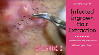 Infected Ingrown Hair Removal  Episode 2 [upl. by Ellehc598]