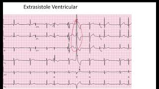 Comparación Extrasistole Auricular vs Ventricular EKG [upl. by Bev]