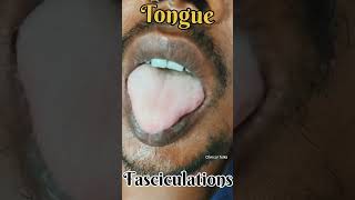 Tongue Fasciculations fasciculation snakebite neurotoxin clinicaltalks [upl. by Neiviv]