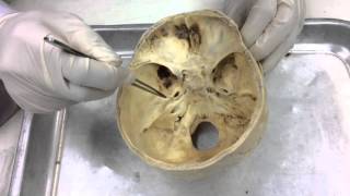 Gross Anat for Dent  Meninges intradural venous sinuses amp cranial fossae [upl. by Phillane]