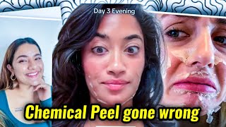 INFLUENCERS NEED TO STOP PROMITING CHEMICAL PEEL AS BEAUTY TREATMENT [upl. by Ennahs787]