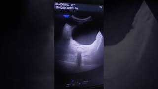 chronic cystitis  inflammation in urine bladder sonography sonographer ultrasounds video [upl. by Ester]