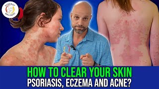 How To Clear Your Skin Eczema Psoriasis Acne [upl. by Azarria146]