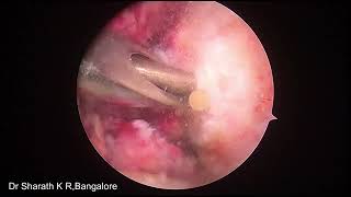 ACLR MEDIAL amp LATERAL MENISCUS ROOT REATTACHMENT REATTACHMEN OF ANTERIOR HORN OF MM  ALL AT ONCE [upl. by Ahola]