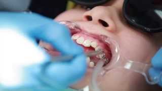 Braces Putting Braces On Bonding Procedure  Aura Orthodontics [upl. by Berey]