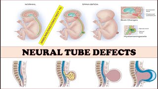 NeuraltubedefectsspinabifidameningomyelocelemeningoceleAnencephalyEncephalocele [upl. by Ellen861]