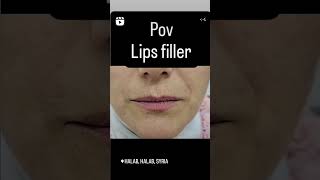 فيلر الشفاهlips filler explore اكسبلور lipfiller ترند filler pov تيكتوك lips شفاه تجميل [upl. by Pubilis676]