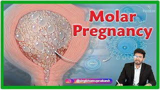 Molar Pregnancy  Causes Clinical manifestations Diagnosis and Treatment [upl. by Shanta329]