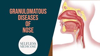 GRANULOMATOUS DISEASES OF NOSE part 2 tuberculosis and leprosy and fungal infections in detail [upl. by Ynnelg]