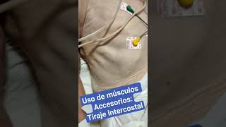 Uso de Músculos Accesorios Tiraje intercostal [upl. by Eeliak]