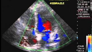 Echocardiography and Color Flow Doppler [upl. by Hedley268]