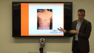 Pectus Defects Presentation [upl. by Treva761]