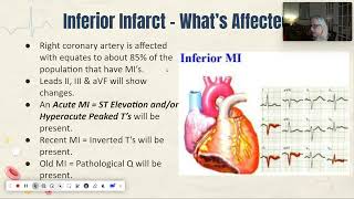 EXS 225 Unit 2 Lesson 2 Part 2  Ischemia amp Infarctions [upl. by Yattirb634]