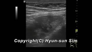 Typhlitis ultrasonography맹장염 [upl. by Ynoyrb960]