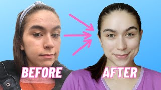 What my skin looks like one year after Accutane Isotretinoin [upl. by Gnilrits20]