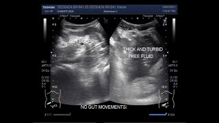 Intestinal obstruction with Perforation [upl. by Dorsey478]