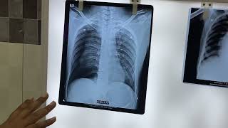 Pneumothorax Vs Pleural effusion [upl. by Chuch]