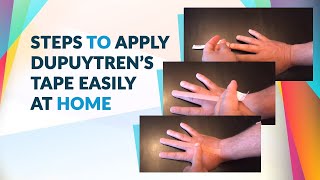 Dupuytren’s Tape Training  Dupuytrens Contracture Home Treatment [upl. by Brittan163]